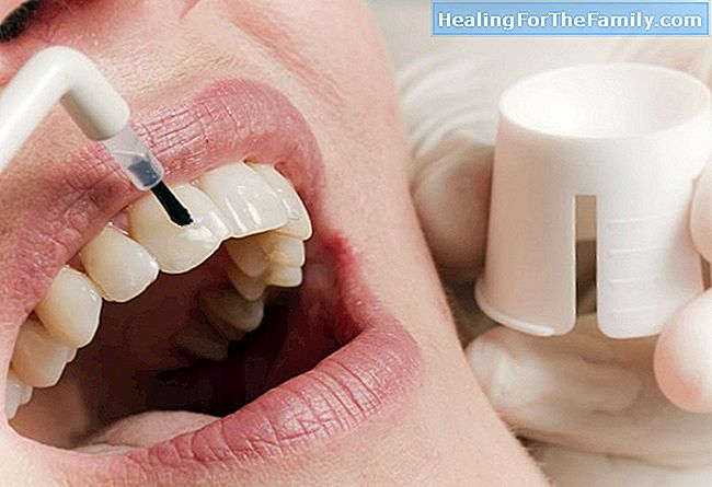 Viktigheten av tann fluorisering i barn