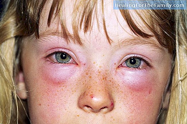 Typer allergiske reaksjoner på insektstikk hos barn