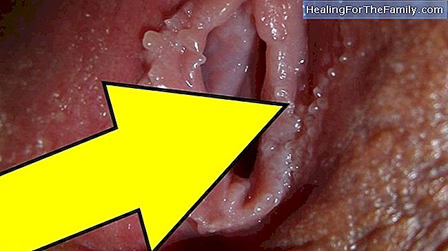 Vaginal herpes i svangerskapet