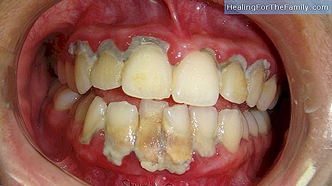 Causas de dentes abarrotados de crianças