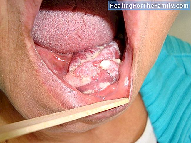 Causas de manchas nos dentes das crianças