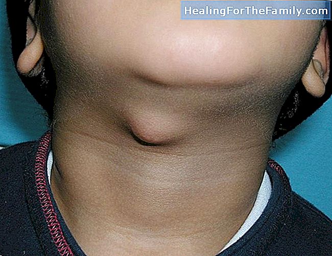 Câncer de pele em crianças: como reconhecer melanoma