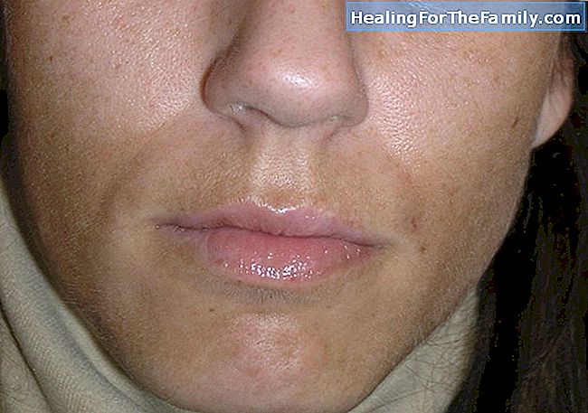 Chloasma ou manchas de gravidez no rosto