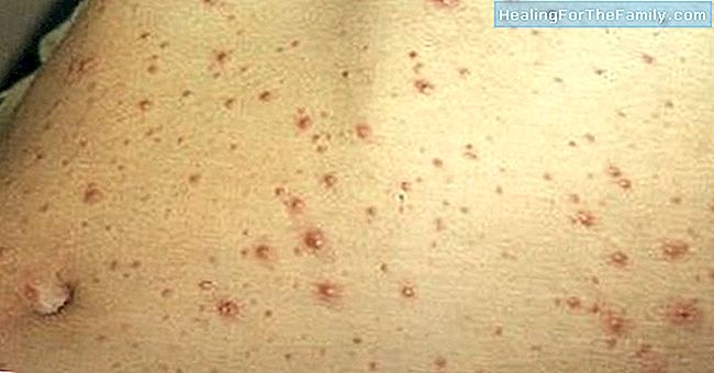 Como a varicela afeta mulheres gravidas