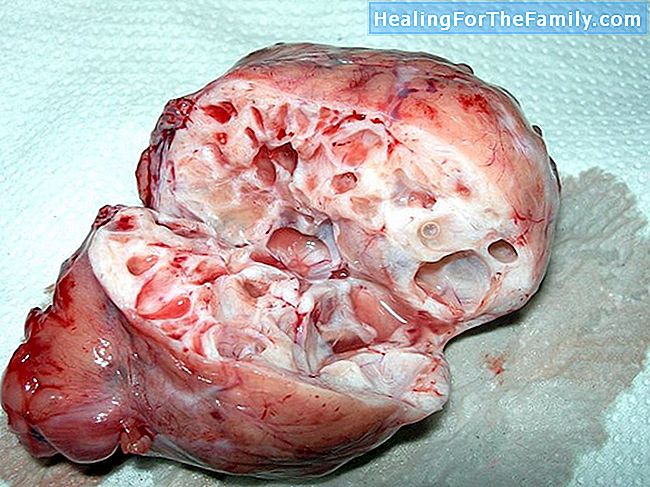 Vírus do papiloma humano em mulheres e gravidez
