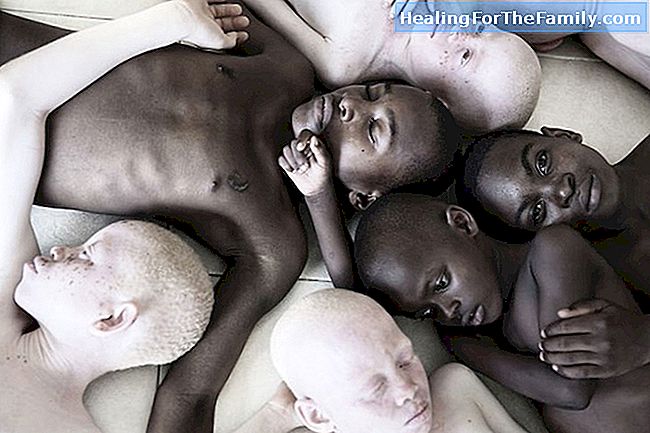 Copii albinoși. Albinism în copilărie