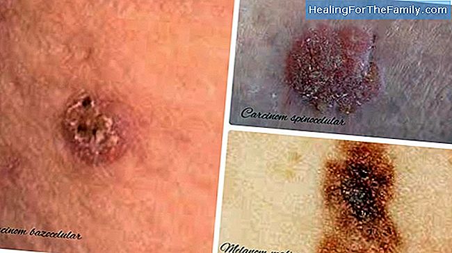 Cancer de piele la copii: cum sa recunoasca melanomul
