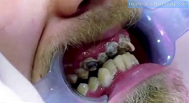 De ce există dinți care nu se încadrează în copilărie