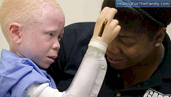 Albino barn. Albinism i barndomen
