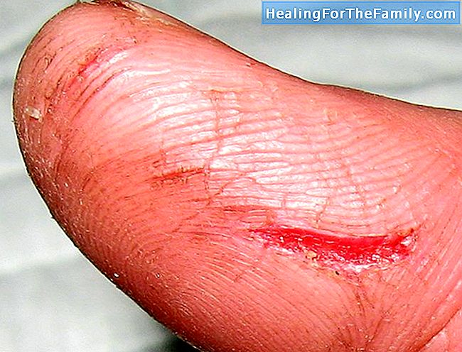 Hur man läka ett sår eller blödning hemma