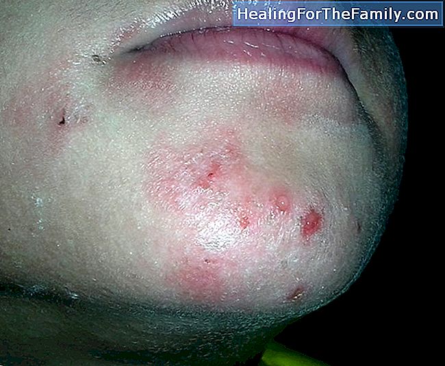 Vad är blötdjur på barns hud. Symptom och behandling