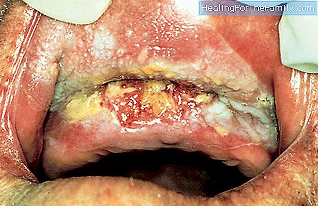 Vad är gingivostomatit. Svullnad i munnen hos spädbarn och barn