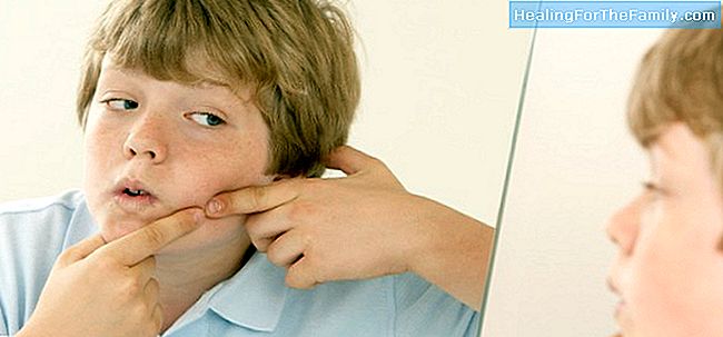5 Trucuri pentru a elimina acnee la copii