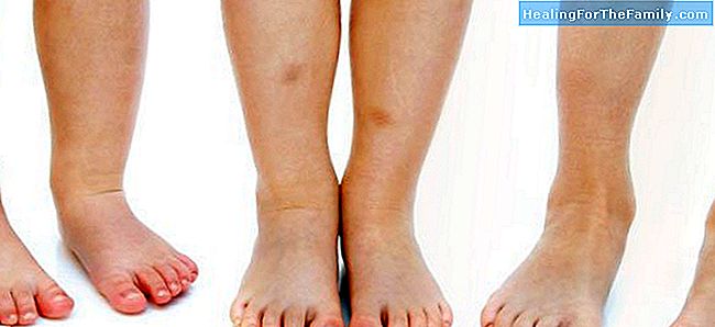 Hématomes et ecchymoses sur les jambes des enfants
