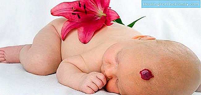 Hémangiomes de la peau de bébé