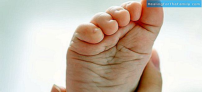 Meest voorkomende orthopedische voetproblemen kinderen