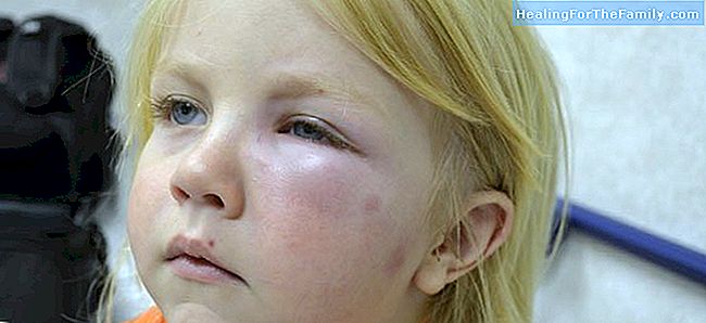 Tipos de reações alérgicas a picadas de insetos em crianças