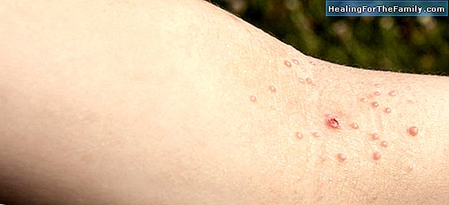 Quais são os moluscos na pele das crianças. Sintomas e tratamento