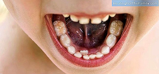 De ce copiii cu un al doilea rând de dinți