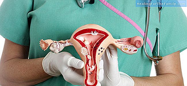 Het polycysteus ovarium syndroom en onvruchtbaarheid